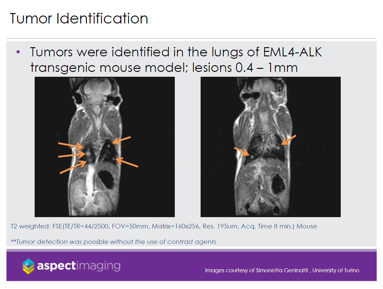 Tumor Identification